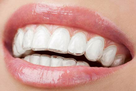Invisalign Aligners: Are They Right for You?